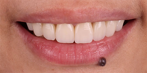 smiling teeth - Cillo Smile Design