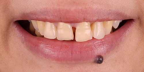 smiling teeth - Cillo Smile Design