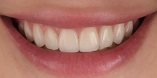 smiling teeth - Cillo Smile Design
