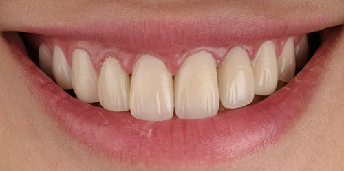 smiling teeth - Cillo Smile Design