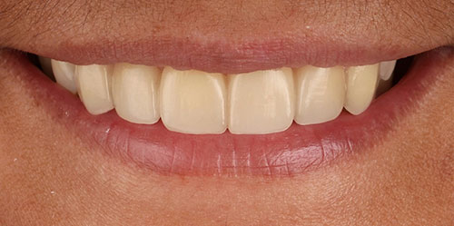 smiling teeth - Cillo Smile Design