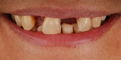 smiling teeth - Cillo Smile Design