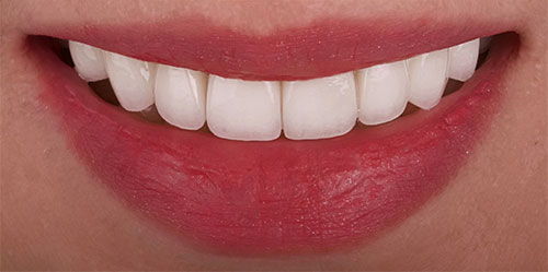 smiling teeth - Cillo Smile Design