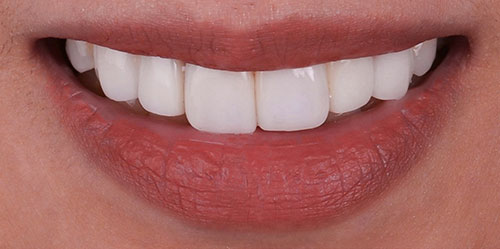 smiling teeth - Cillo Smile Design
