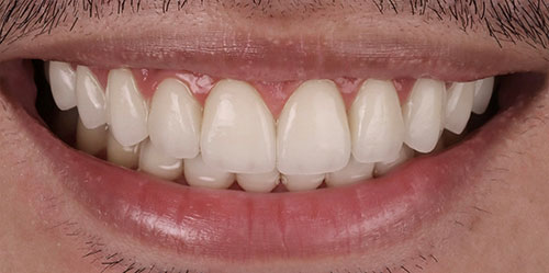 smiling teeth - Cillo Smile Design