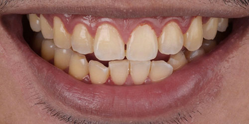 smiling teeth - Cillo Smile Design