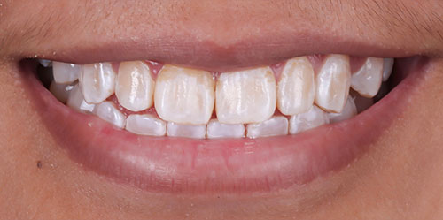 smiling teeth - Cillo Smile Design