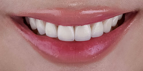 smiling teeth - Cillo Smile Design