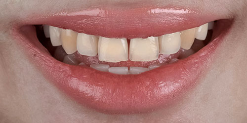 smiling teeth - Cillo Smile Design
