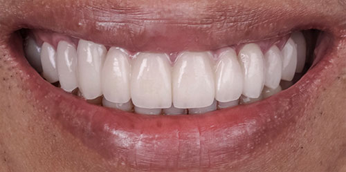 smiling teeth - Cillo Smile Design