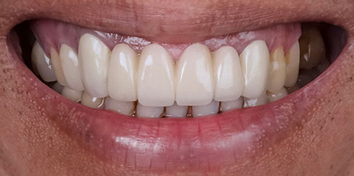 smiling teeth - Cillo Smile Design