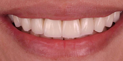 smiling teeth - Cillo Smile Design