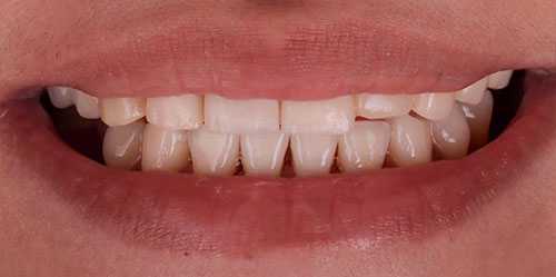 smiling teeth - Cillo Smile Design
