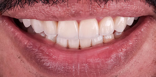 smiling teeth - Cillo Smile Design