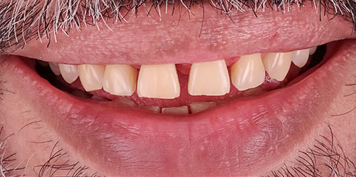 smiling teeth - Cillo Smile Design