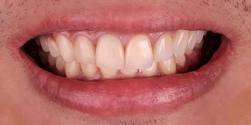 smiling teeth - Cillo Smile Design