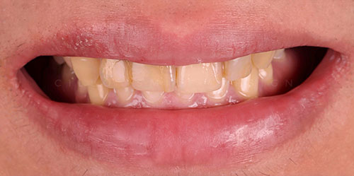 smiling teeth - Cillo Smile Design