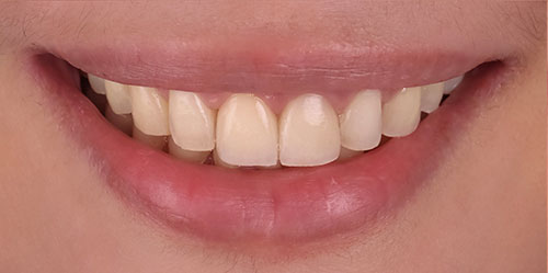smiling teeth - Cillo Smile Design
