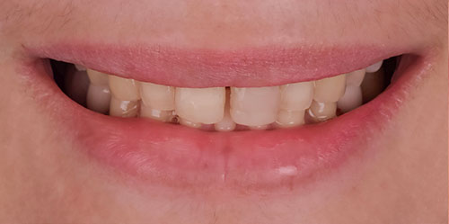 smiling teeth - Cillo Smile Design