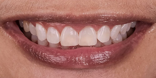 smiling teeth - Cillo Smile Design