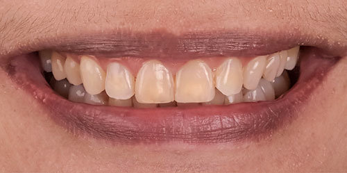 smiling teeth - Cillo Smile Design