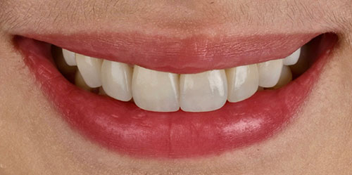 smiling teeth - Cillo Smile Design