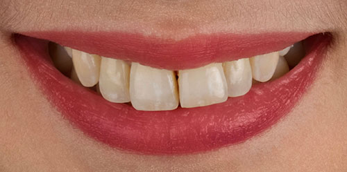 smiling teeth - Cillo Smile Design