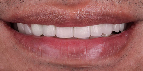 smiling teeth - Cillo Smile Design