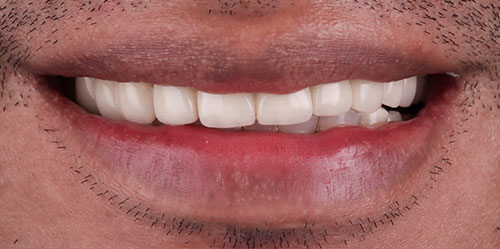 smiling teeth - Cillo Smile Design