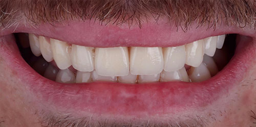 smiling teeth - Cillo Smile Design