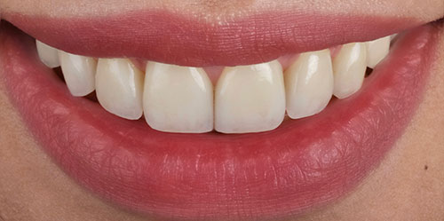 smiling teeth - Cillo Smile Design