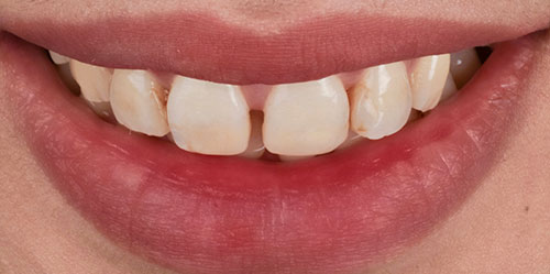smiling teeth - Cillo Smile Design