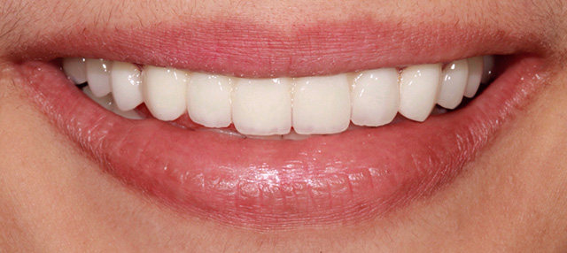 smiling teeth - Cillo Smile Design