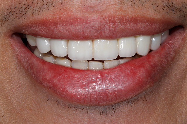 smiling teeth - Cillo Smile Design