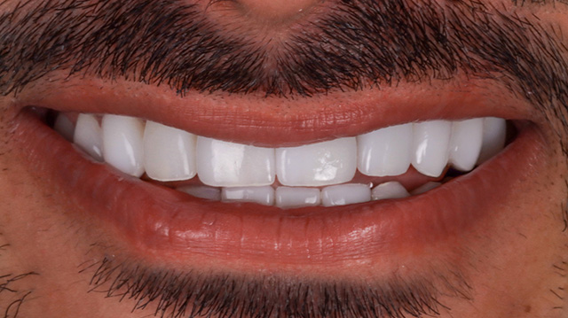 smiling teeth - Cillo Smile Design