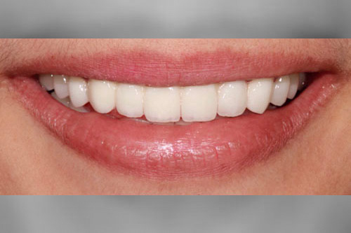 smiling teeth - Cillo Smile Design