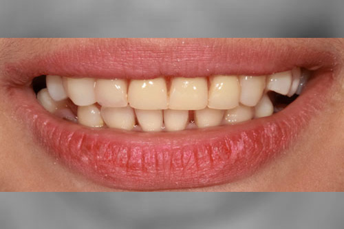 smiling teeth - Cillo Smile Design