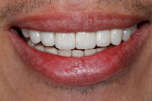 smiling teeth - Cillo Smile Design