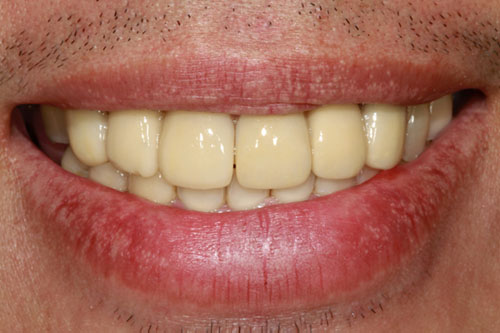 smiling teeth - Cillo Smile Design