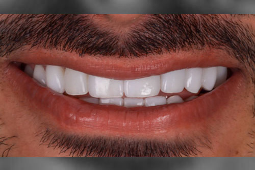 smiling teeth - Cillo Smile Design