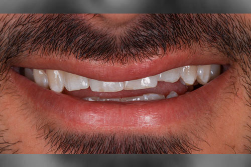smiling teeth - Cillo Smile Design