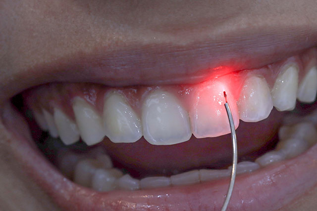 laser treatment for teeth - Cillo Smile Design