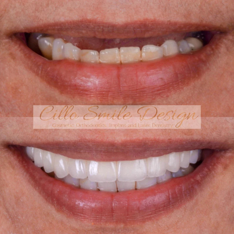 before and after teeth picture - Cillo Smile Design