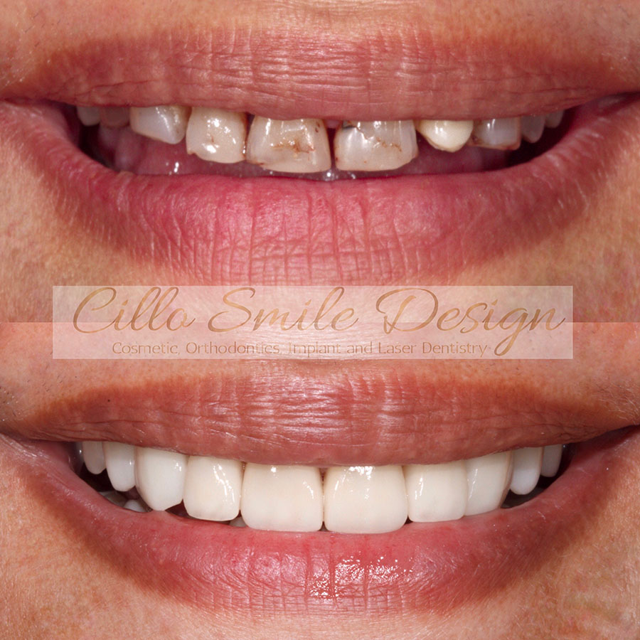 before and after teeth picture - Cillo Smile Design