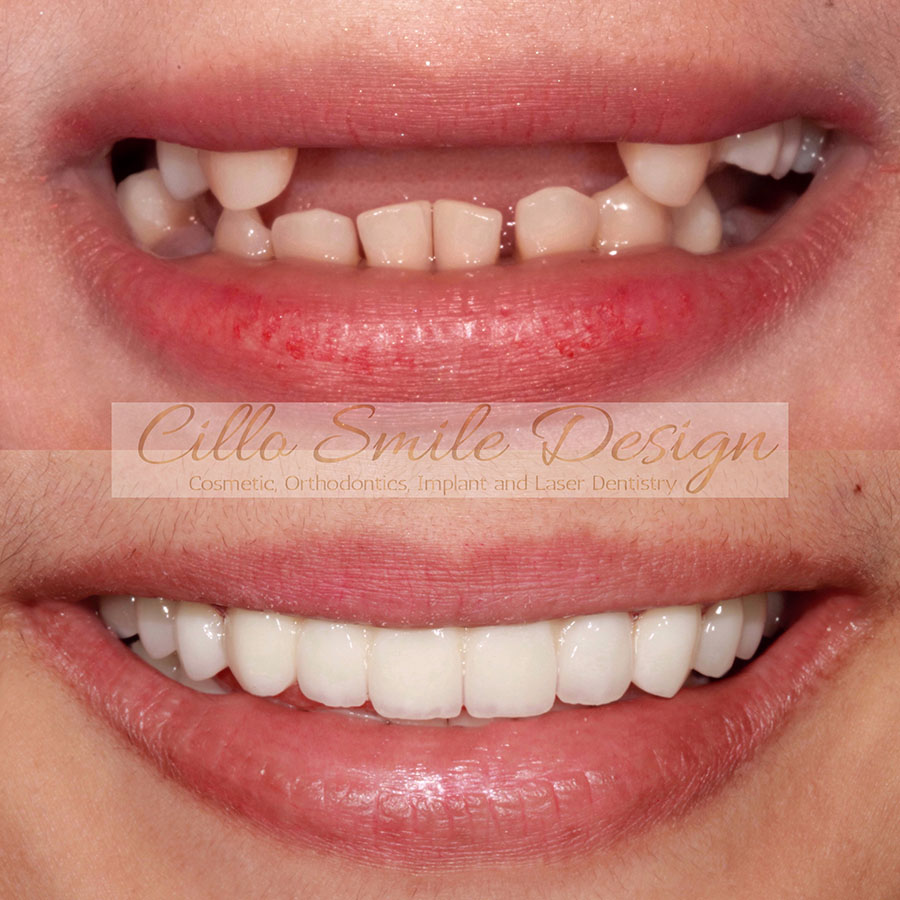 before and after teeth picture - Cillo Smile Design