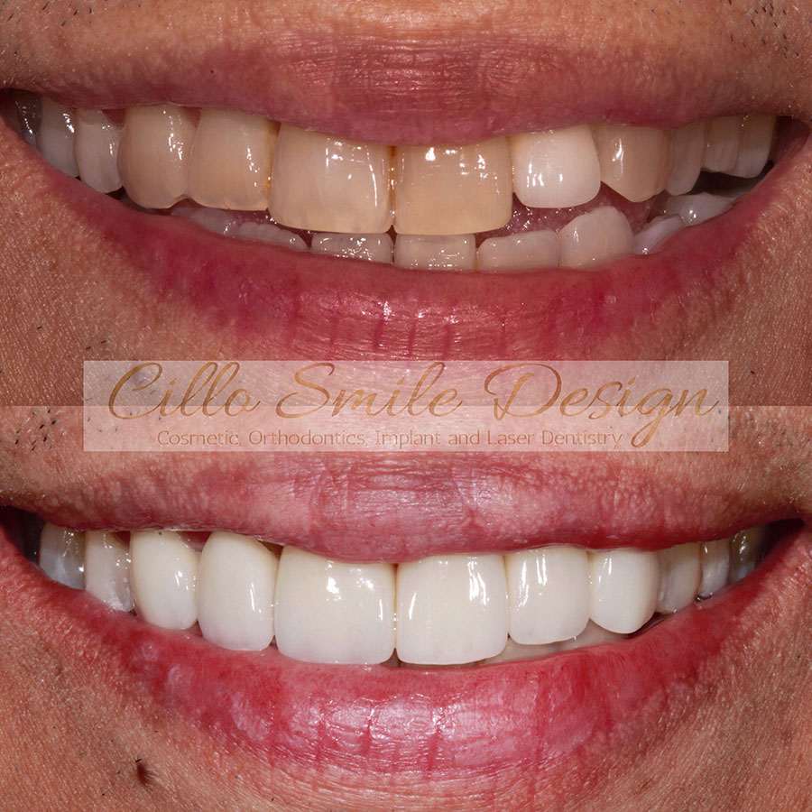 before and after teeth picture - Cillo Smile Design