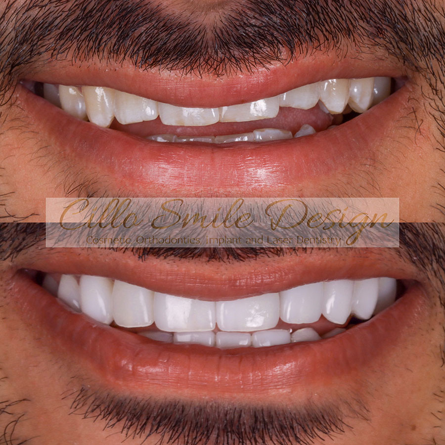 before and after teeth picture - Cillo Smile Design