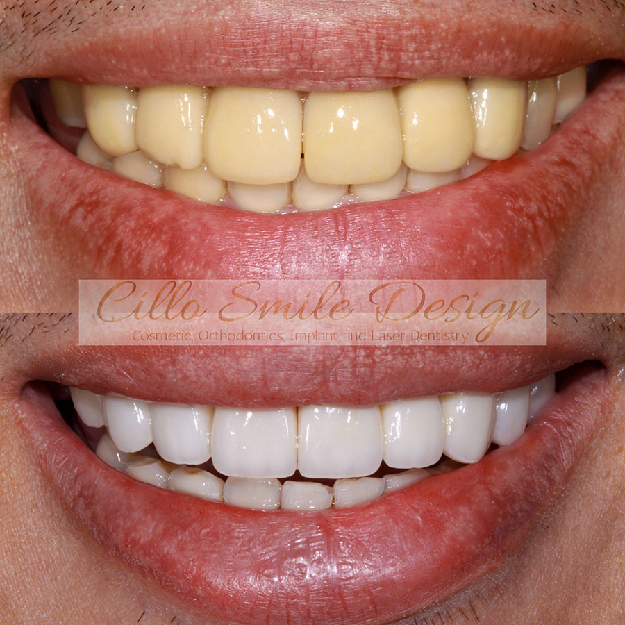 before and after teeth picture - Cillo Smile Design