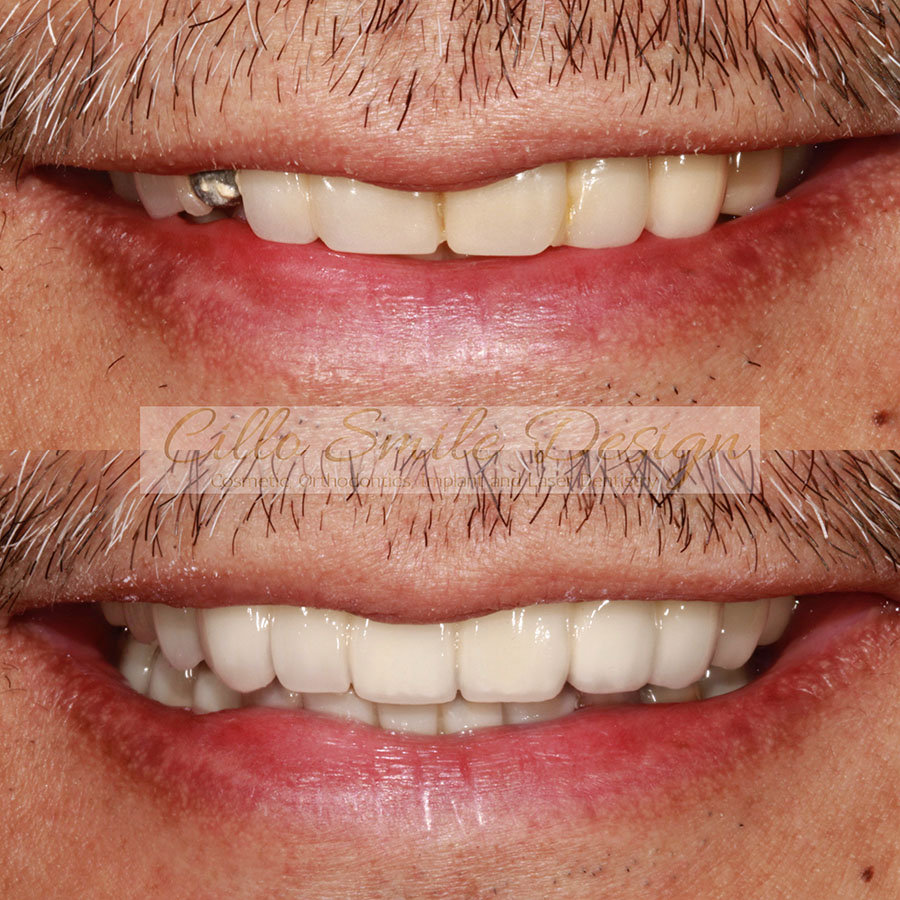 before and after teeth picture - Cillo Smile Design