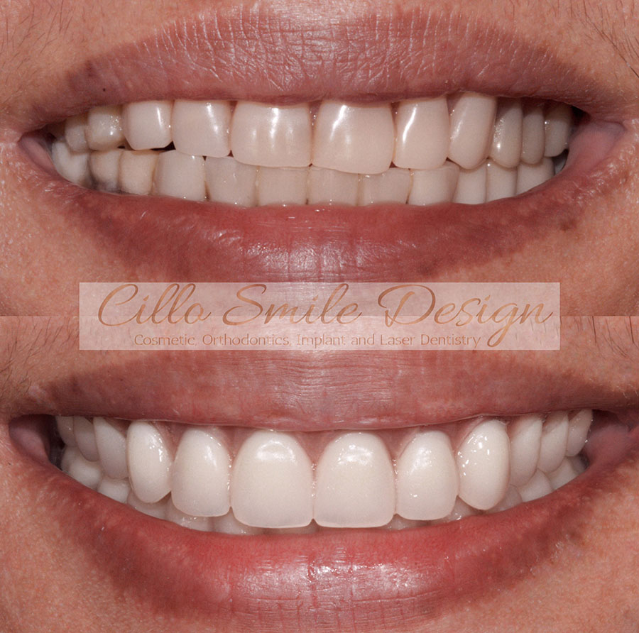 before and after teeth picture - Cillo Smile Design